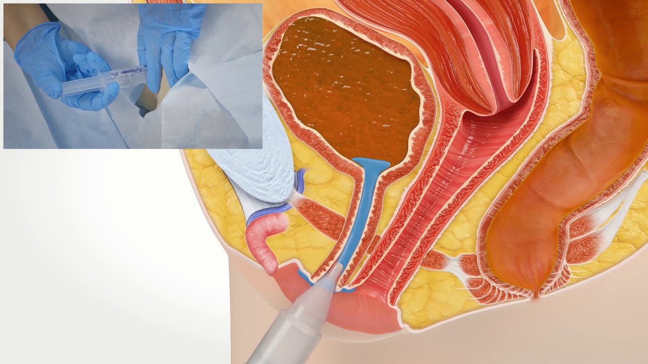 Katheterisierung mit Blasenkatheter: Weiblich - YouTube - Bloedstolsels In Urine Man Katheter