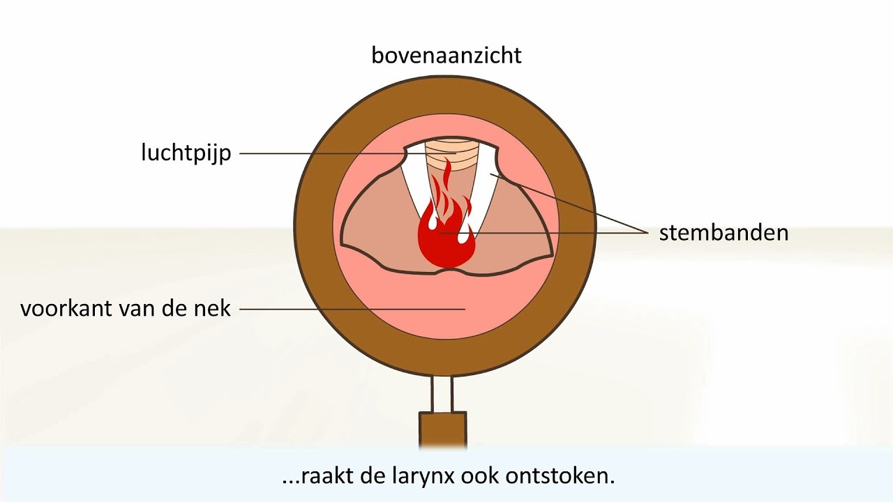 Keelontsteking - de oorzaak en behandeling - YouTube - Hoe Lang Is Keelontsteking Besmettelijk