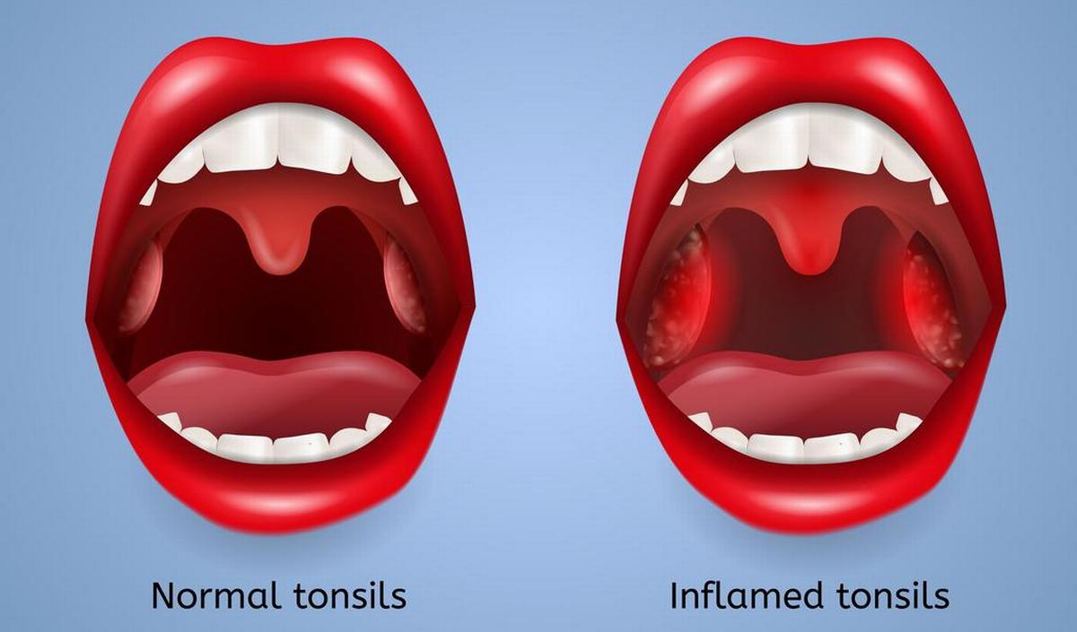 Keelontsteking: ontsteking van de keelamandelen (tonsillitis - Hoe Lang Is Bacteriële Keelontsteking Besmettelijk