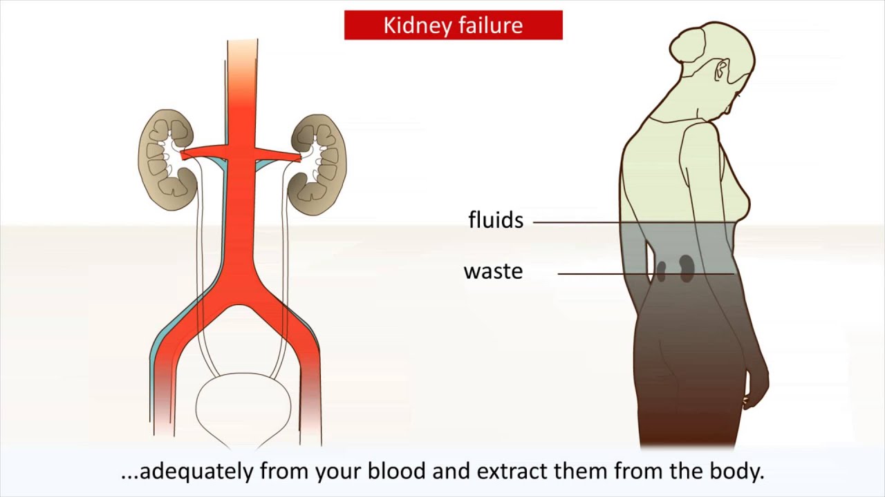 Kidney disease - Causes and treatment of kidney failure - YouTube - Waar Heb Je Jeuk Bij Nierfalen