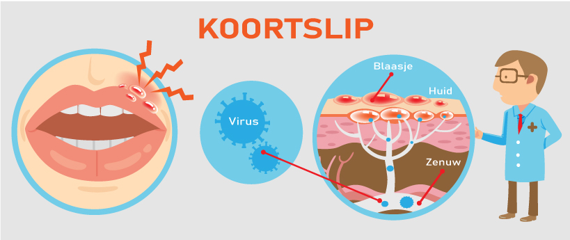 Koortslip: symptomen + wat er aan te doen? - Zorgwijzer - Wanneer Is Een Koortslip Niet Meer Besmettelijk