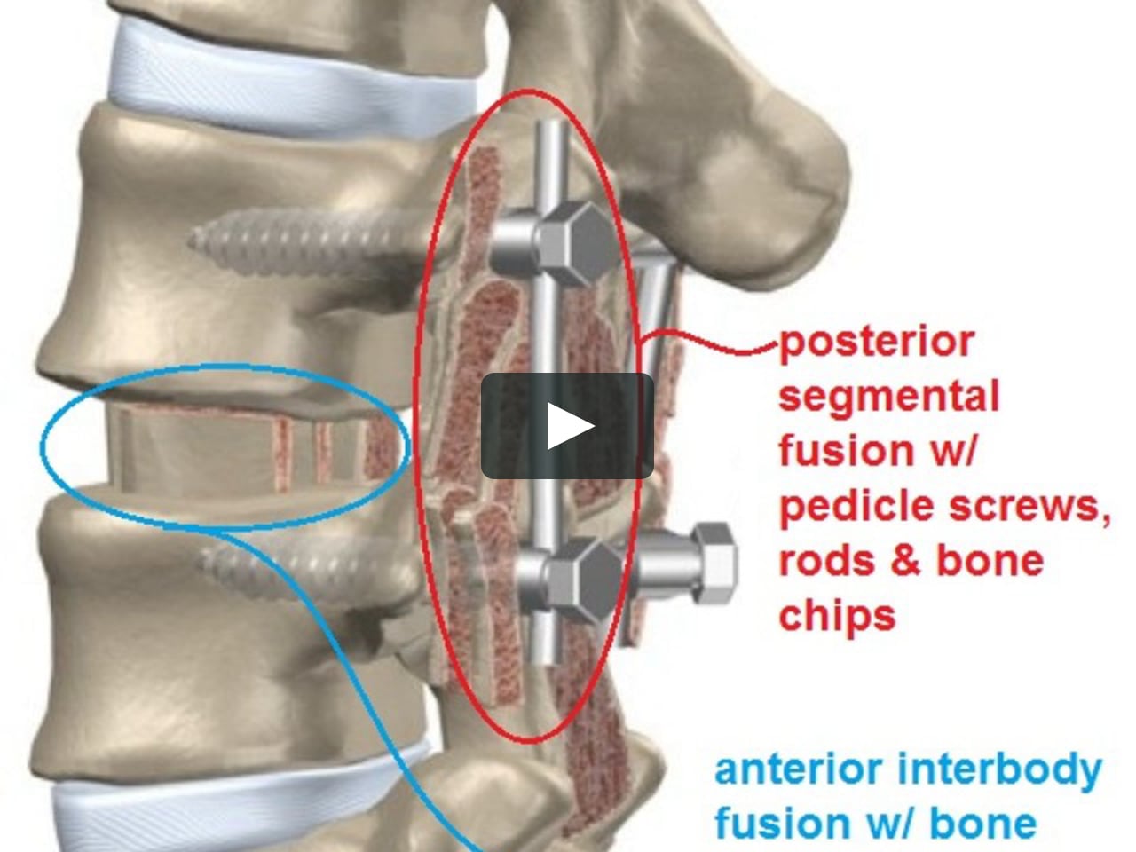 L4-L5 and L5-S1 TLIF for Multi-level Bilateral Foraminal Stenosis (due - Facetartrose L4 L5 En L5 S1