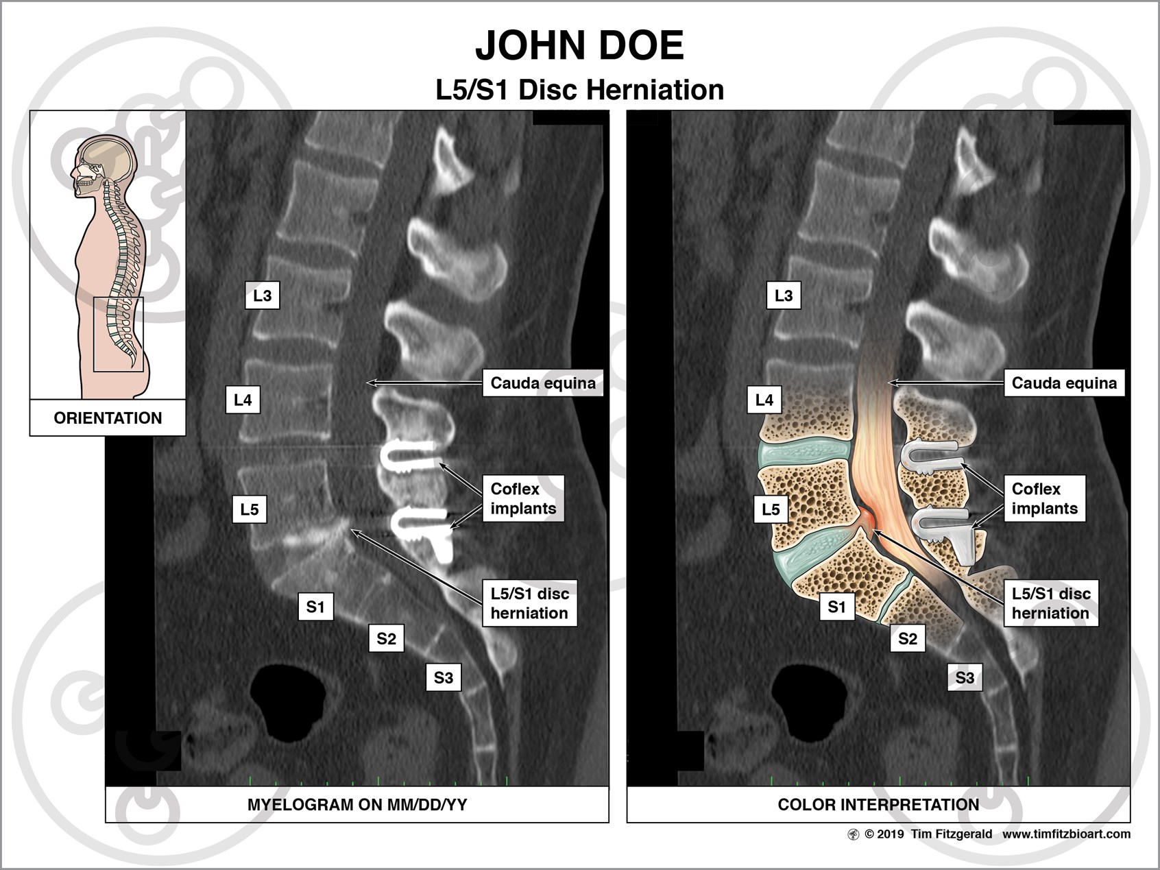 L5/S1 Disc Herniation Illustration by Tim Fitzgerald | Medical - Facetartrose L4 L5 En L5 S1