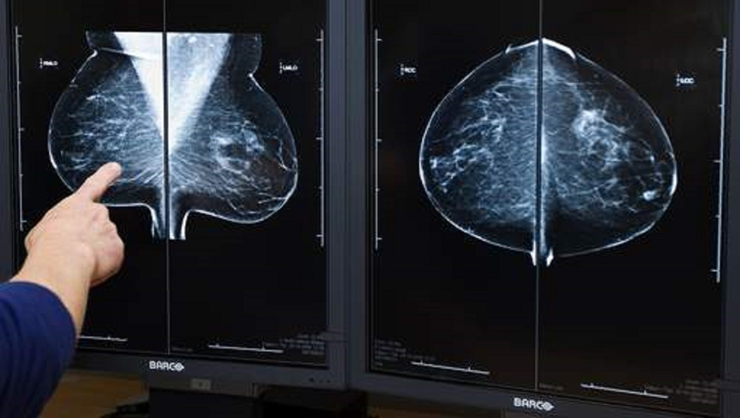 Lagere overlevingskans na borstamputatie bij kanker | Foto | AD.nl - Hoe Ziet Inflammatoire Borstkanker Eruit