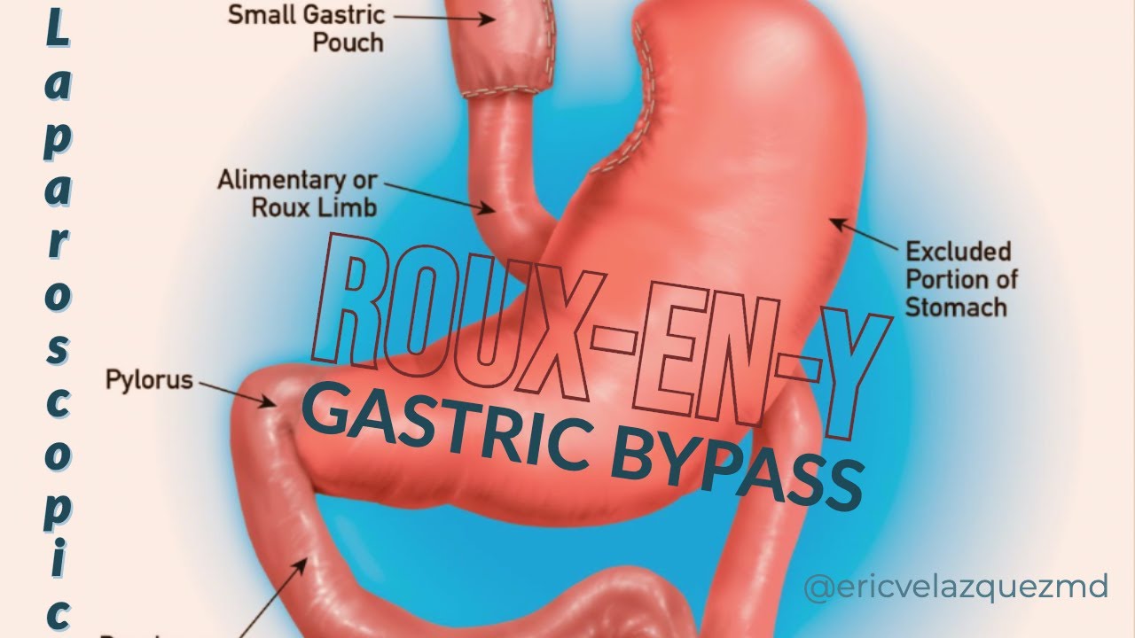 Inwendige Herniatie Na Gastric Bypass