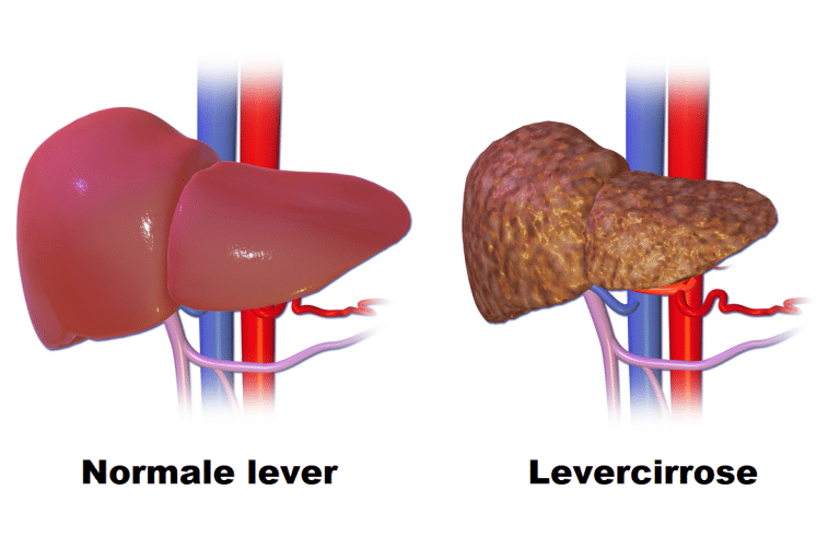 LDH: normaalwaarden en verhoogde waarde in bloed - Mens & Gezondheid - Wat Is Ldh In Het Bloed