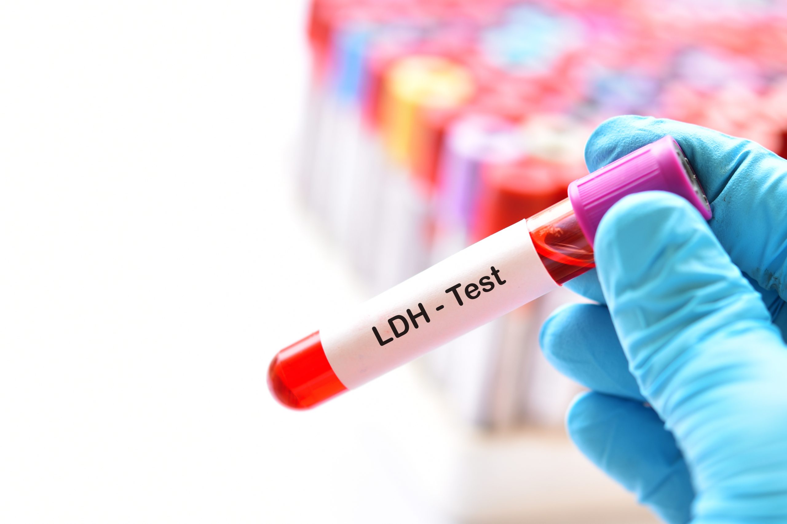 Wat Is Ldh In Het Bloed