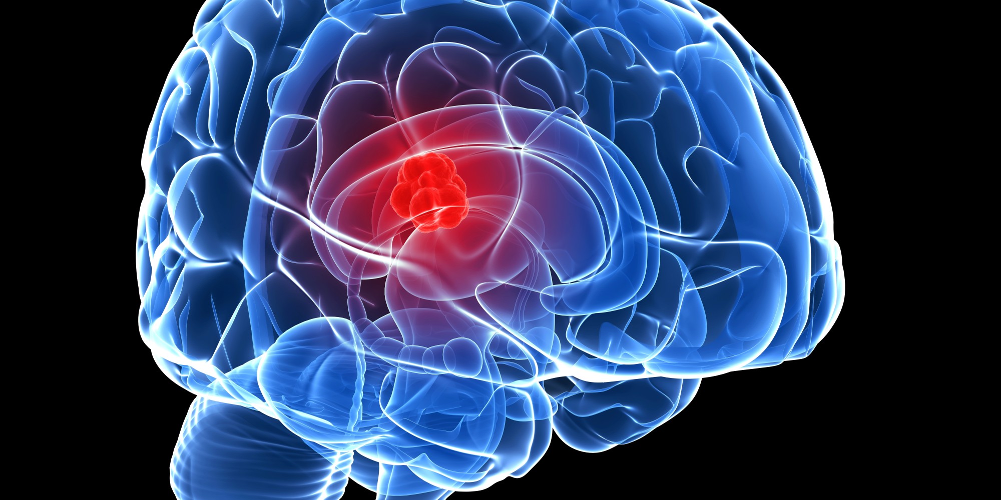 Learn about brain tumors » Preston A. Wells Jr. Centerfor Brain Tumor - Tumor Met Haren En Tanden