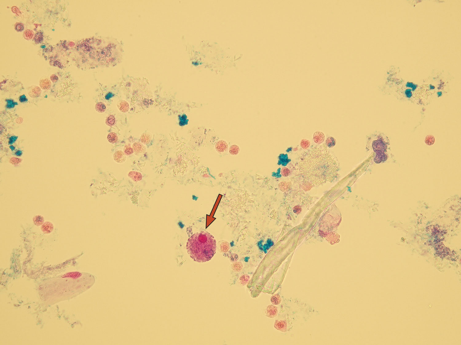 Leukocytes in Urine - Leukocyten En Nitriet In Urine