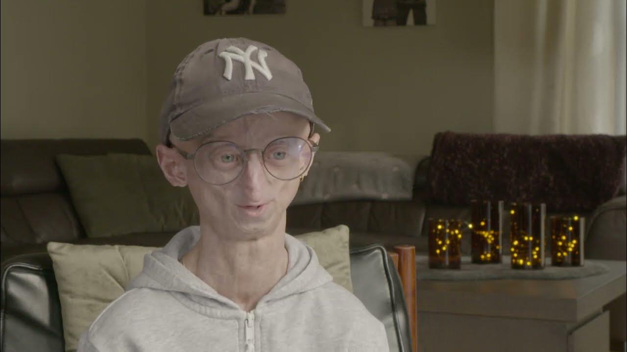 Hoe Oud Worden Mensen Met Progeria