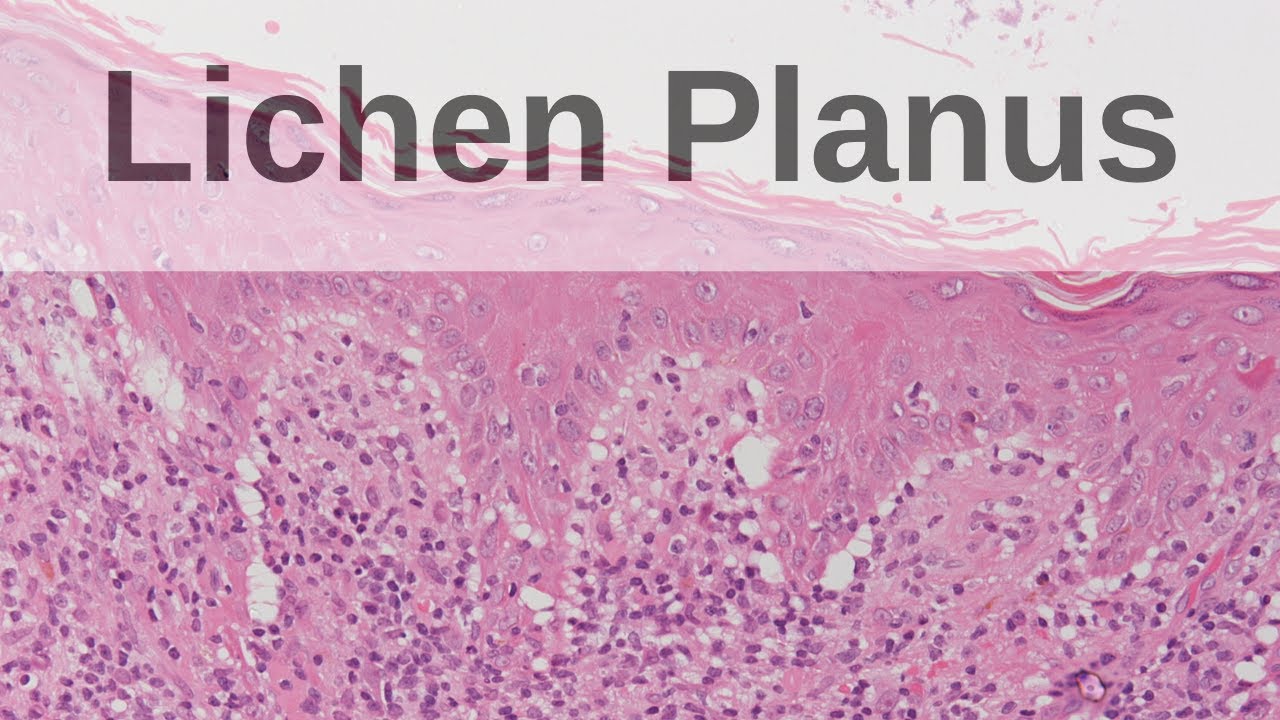 Lichen Planus - Pathology mini tutorial - YouTube - Lichen Planus In De Mond
