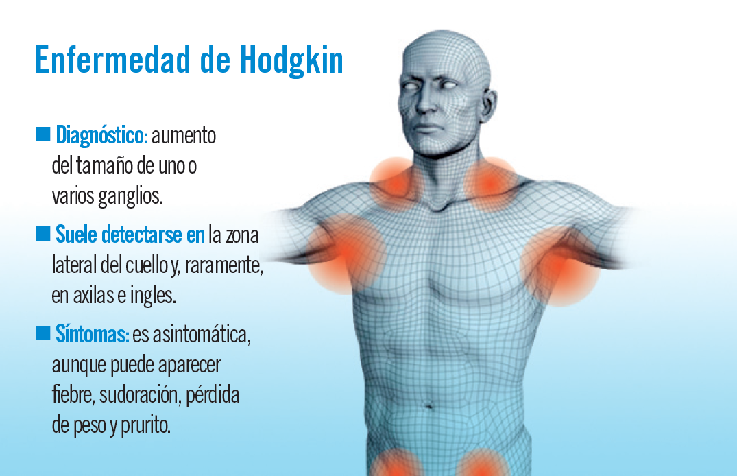 Linfoma de Hodgkin: diagnóstico y tratamiento - Hodgkin En Non Hodgkin Verschil