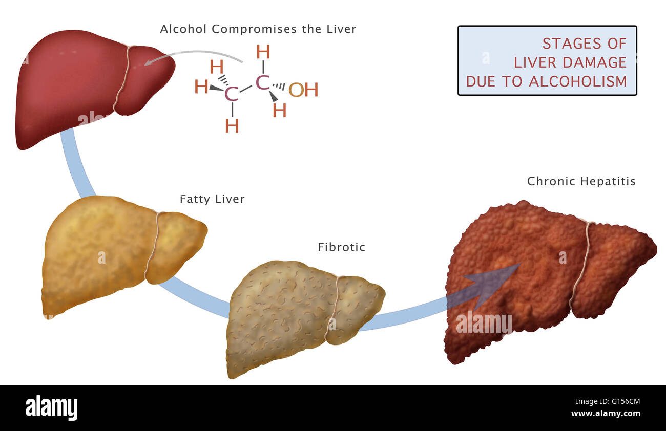 Liver Diseases And Disorders as related to Alcohol Use, Abuse, And - Pijn In Lever Na Alcohol