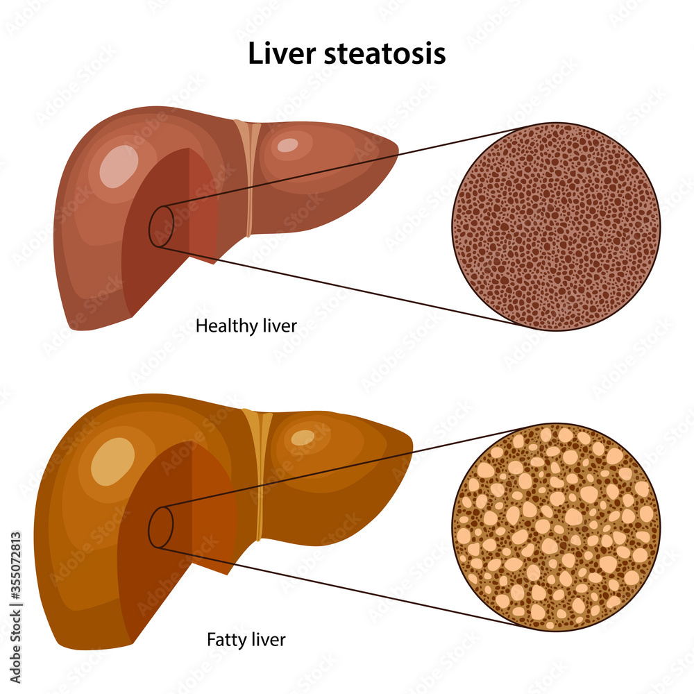 Liver steatosis. Histology of the healthy and fatty liver with - Steatosis Hepatis Met Focale Non-steatose