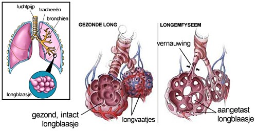 Wat Is Het Verschil Tussen Longemfyseem En Copd