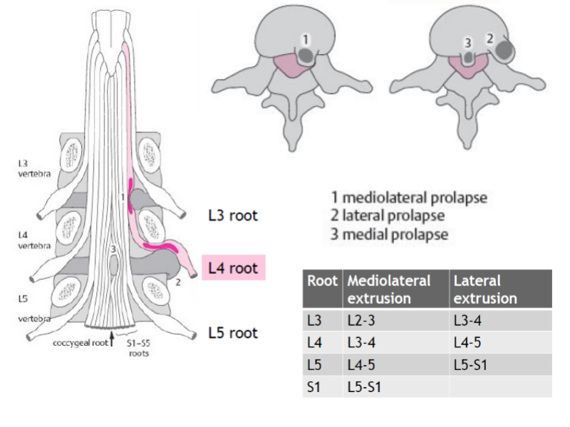 Lumbar Radicular Syndrome Diagnosis Treatment For Physios, 49% OFF - Verschil Radiculair En Pseudoradiculair Syndroom