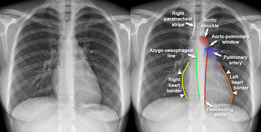 Mediastinum - Wat Betekent Slank Hart En Mediastinum