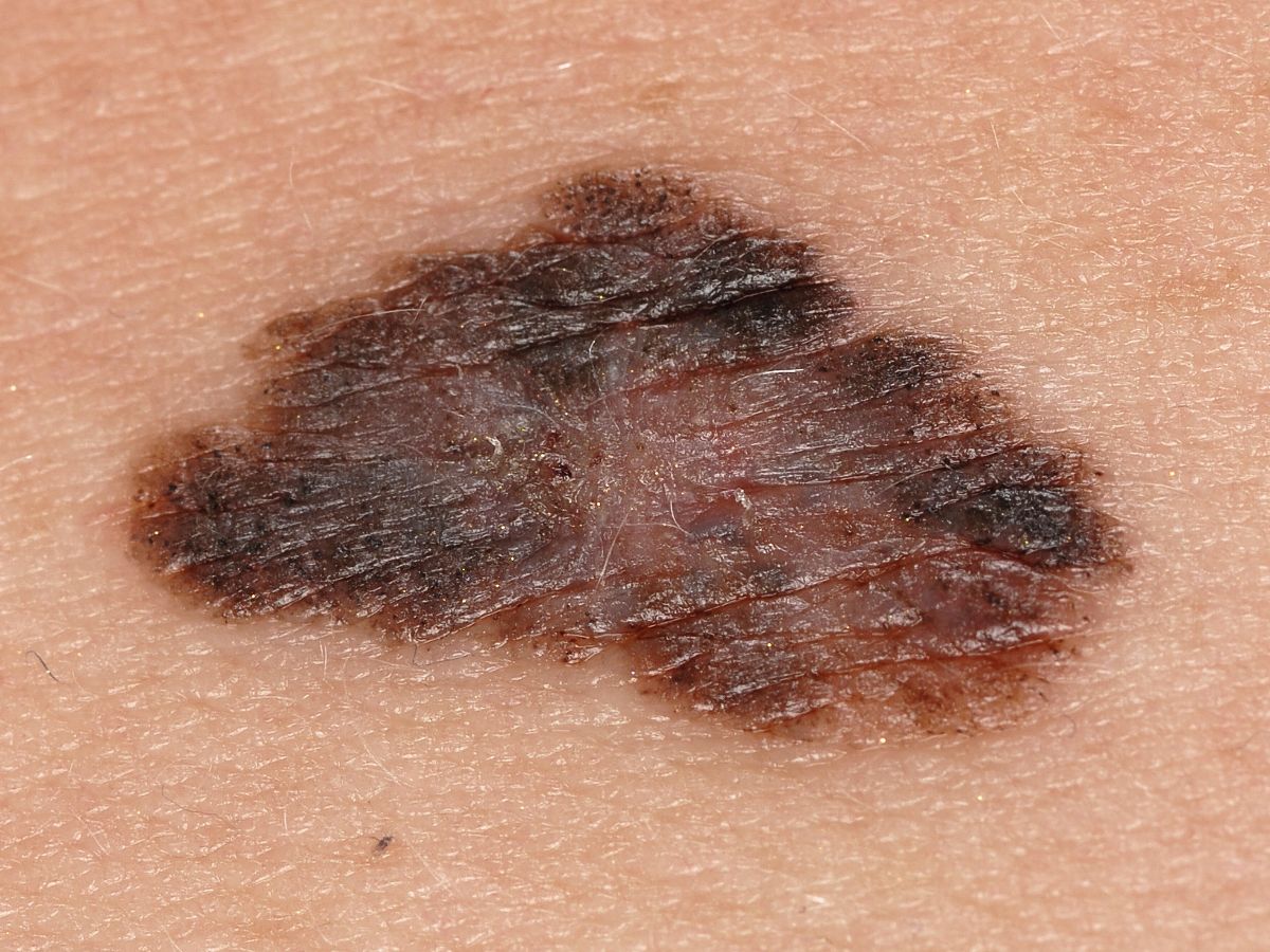 Melanoma - Pictures - Hoe Ziet Een Melanoom Er Uit