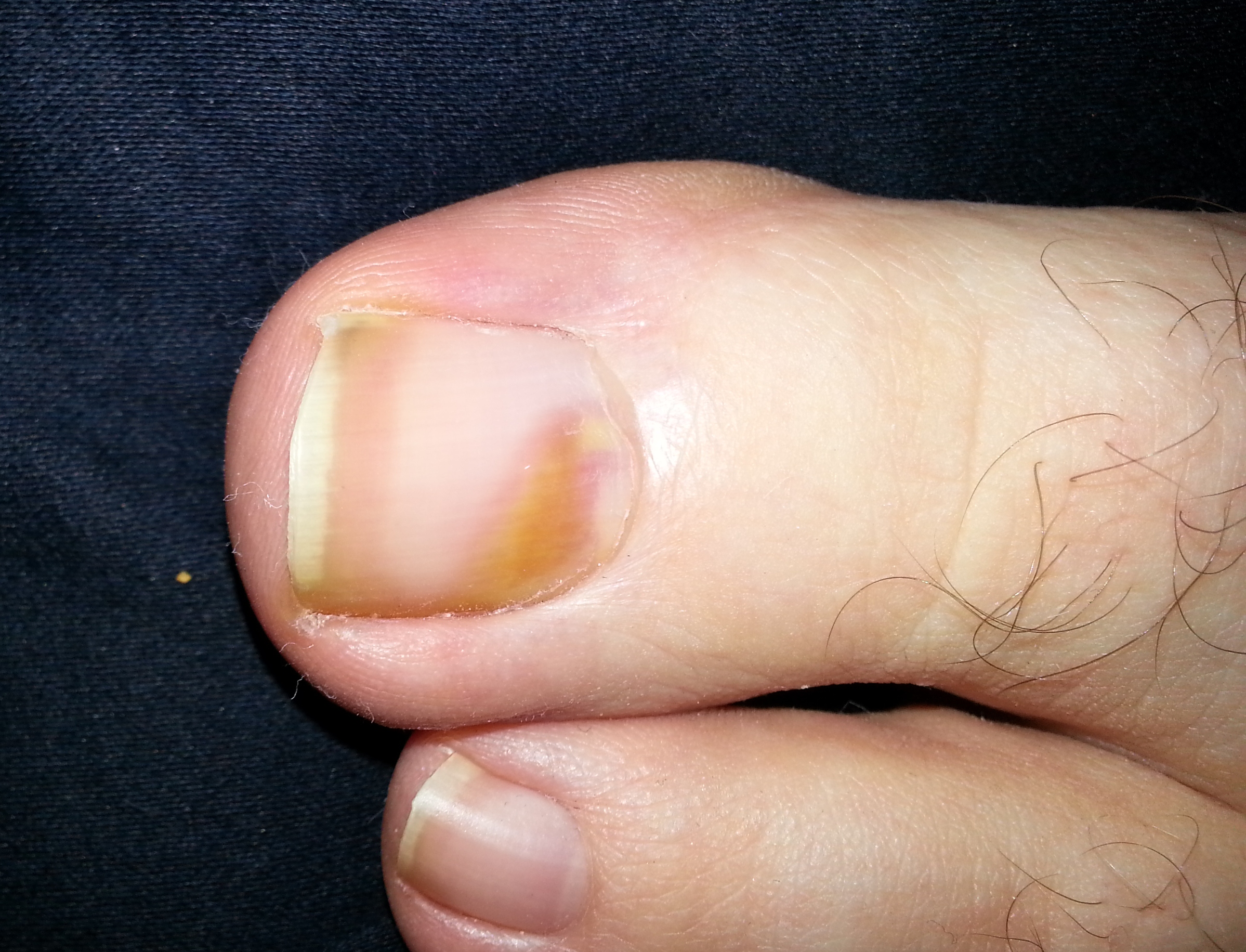 melanoma under toenail - pictures, photos - Bruine Streep Melanoom Nagel Herkennen