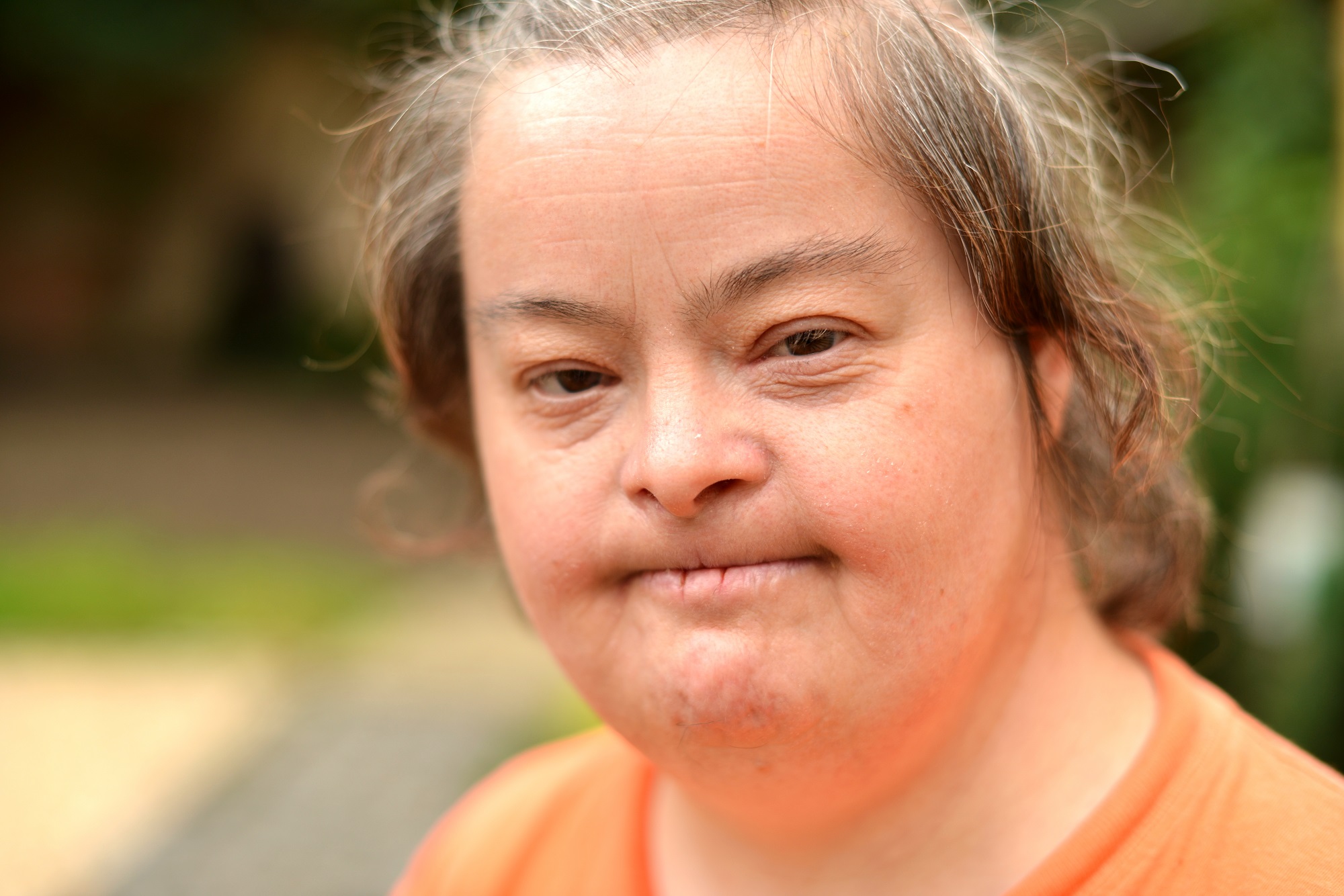 Memantine Therapy for Down Syndrome Shows Little Benefit Among Young - Mensen Met Het Syndroom Van Down