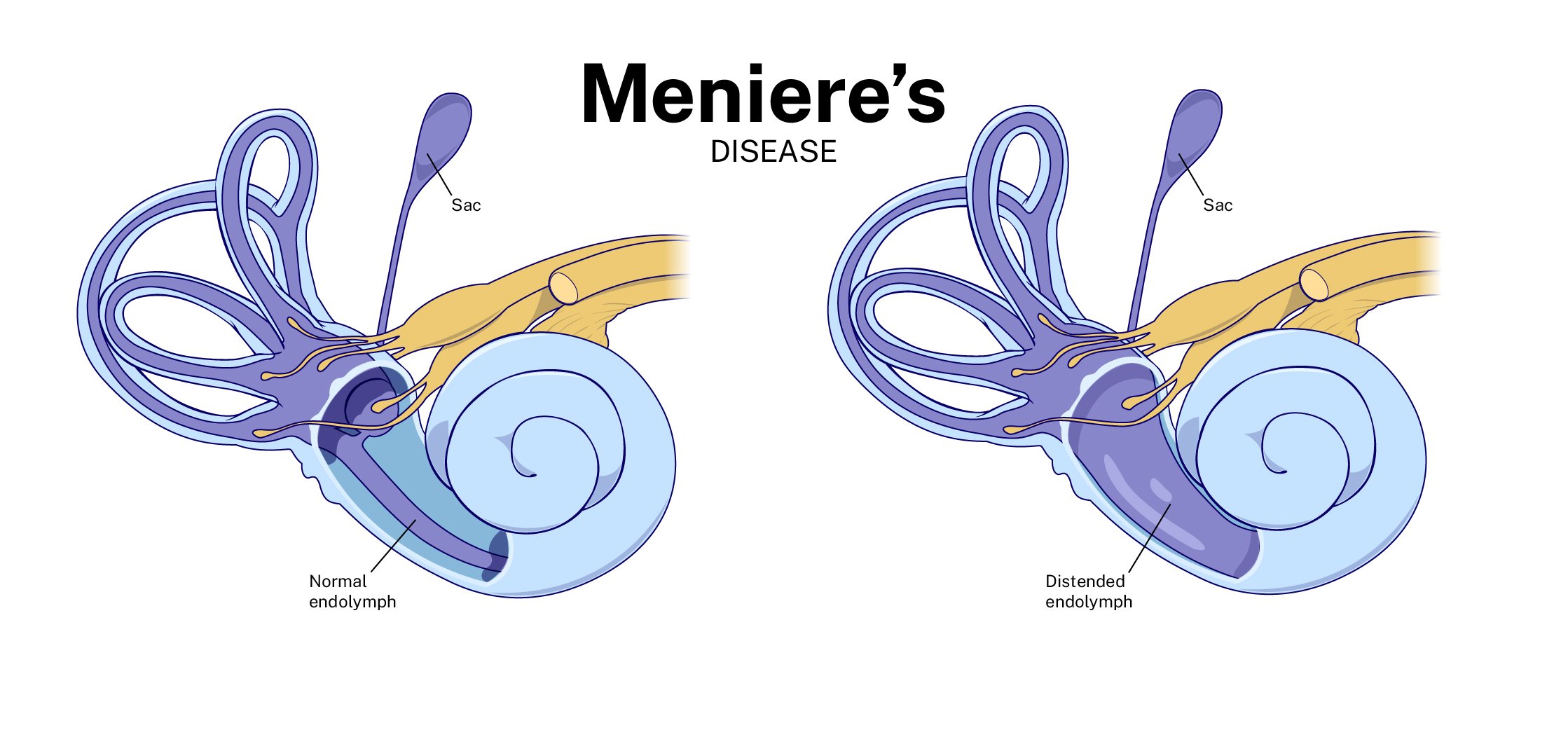 Meniere Syndrome - vrogue.co - Ziekte Van Meniere Eerste Symptomen