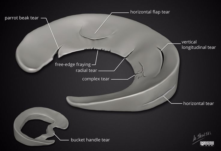 Meniscal tear types. Illustration by Dr. Matt Skalski (Twitter - Horizontale Scheur Achterhoorn Mediale Meniscus