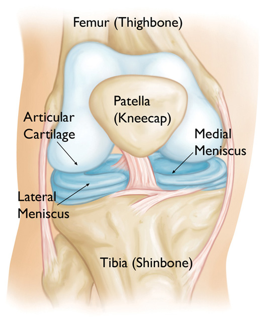 Meniscus Allograft - Florida Knee & Orthopedic Pavilion - Complexe Scheur Achterhoorn Mediale Meniscus