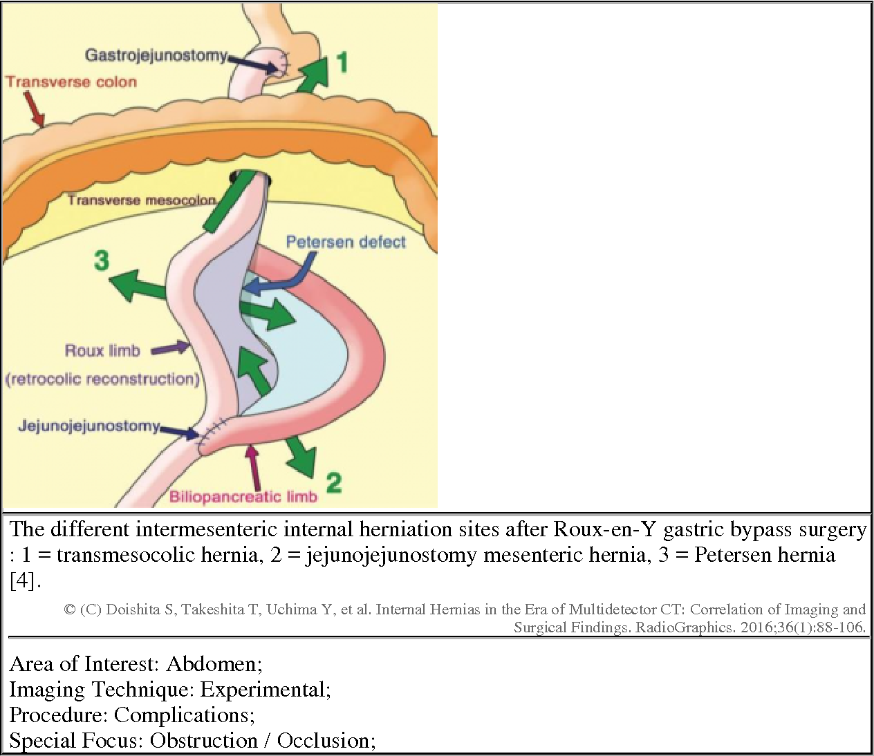 Mesenteric Defect Closure And Prevention Of Internal, 57% OFF - Inwendige Herniatie Na Gastric Bypass Symptomen
