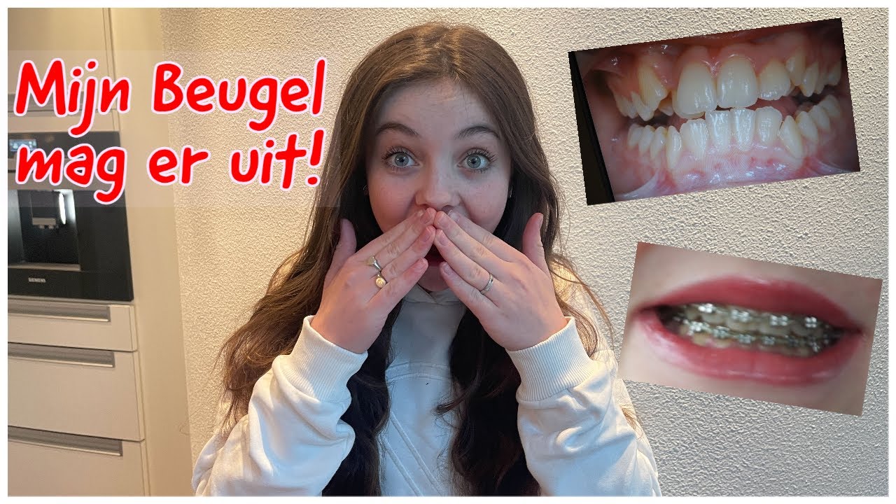 MIJN BEUGEL MAG ER EINDELIJK UIT!!! - Bibi - YouTube - Hoe Lang Mag Je Niet Eten Na Fluor