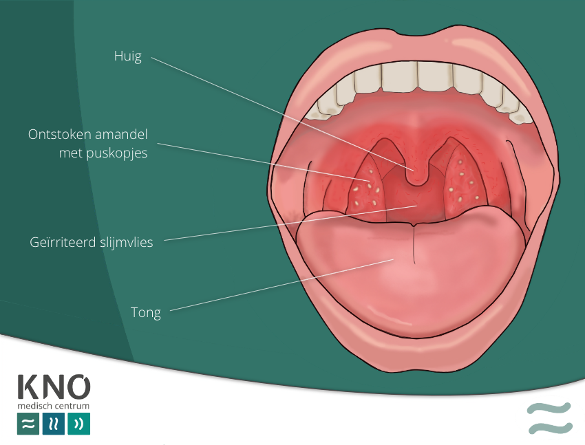 Mild Tonsil Stones - Ziekte Van Pfeiffer Bij Volwassenen