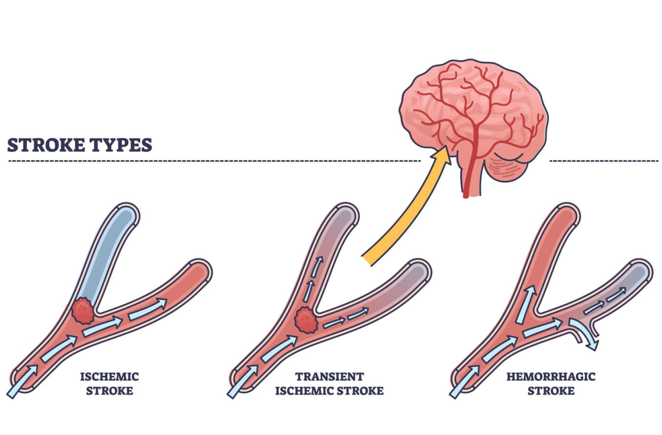 Mini Stroke Symptoms Tia Transient Ischemic Attack Sy - vrogue.co - Wat Is Erger Herseninfarct Links Of Rechts