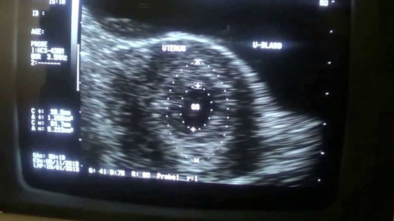 Missed Abortion Hoe Vaak Komt Het Voor