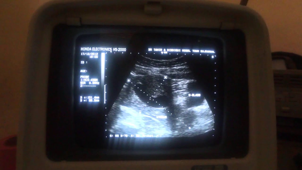 MISSED ABORTION - YouTube - Missed Abortion Hoe Vaak Komt Het Voor