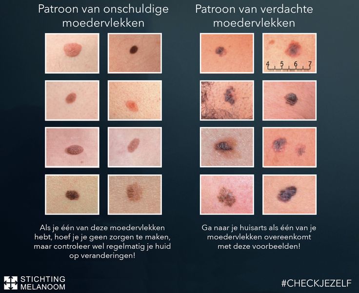 Hoe Ziet Een Huidkanker Plekje Eruit