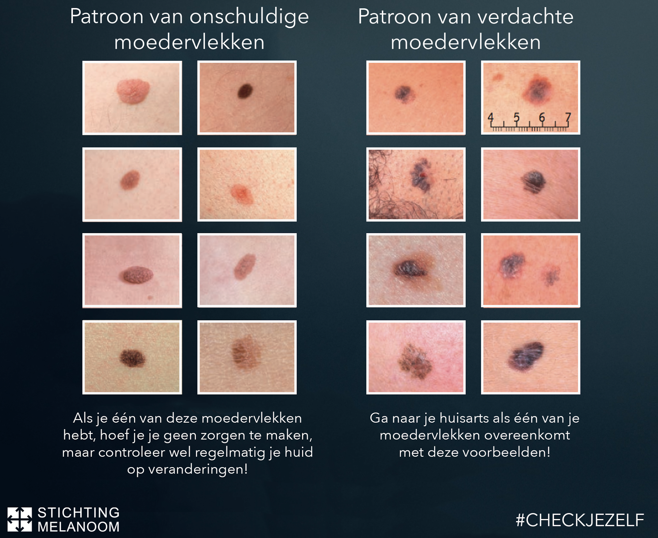 Moedervlekken controleren | nieuws - Gezond, Trucjes voor een beter - Welke Soorten Borstkanker Zijn Er