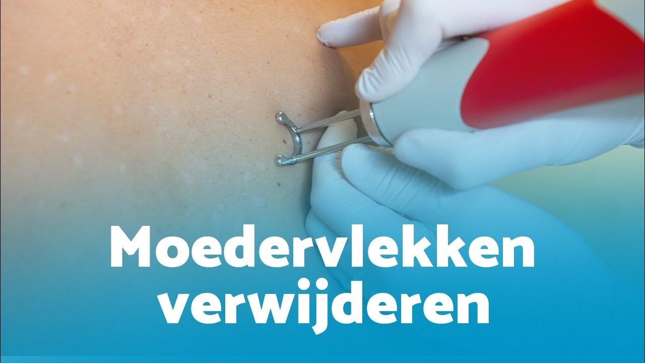 Moedervlekken verwijderen met laser in 2023: pijnloos en littekenvrij - Wanneer Met Moedervlek Naar Huisarts