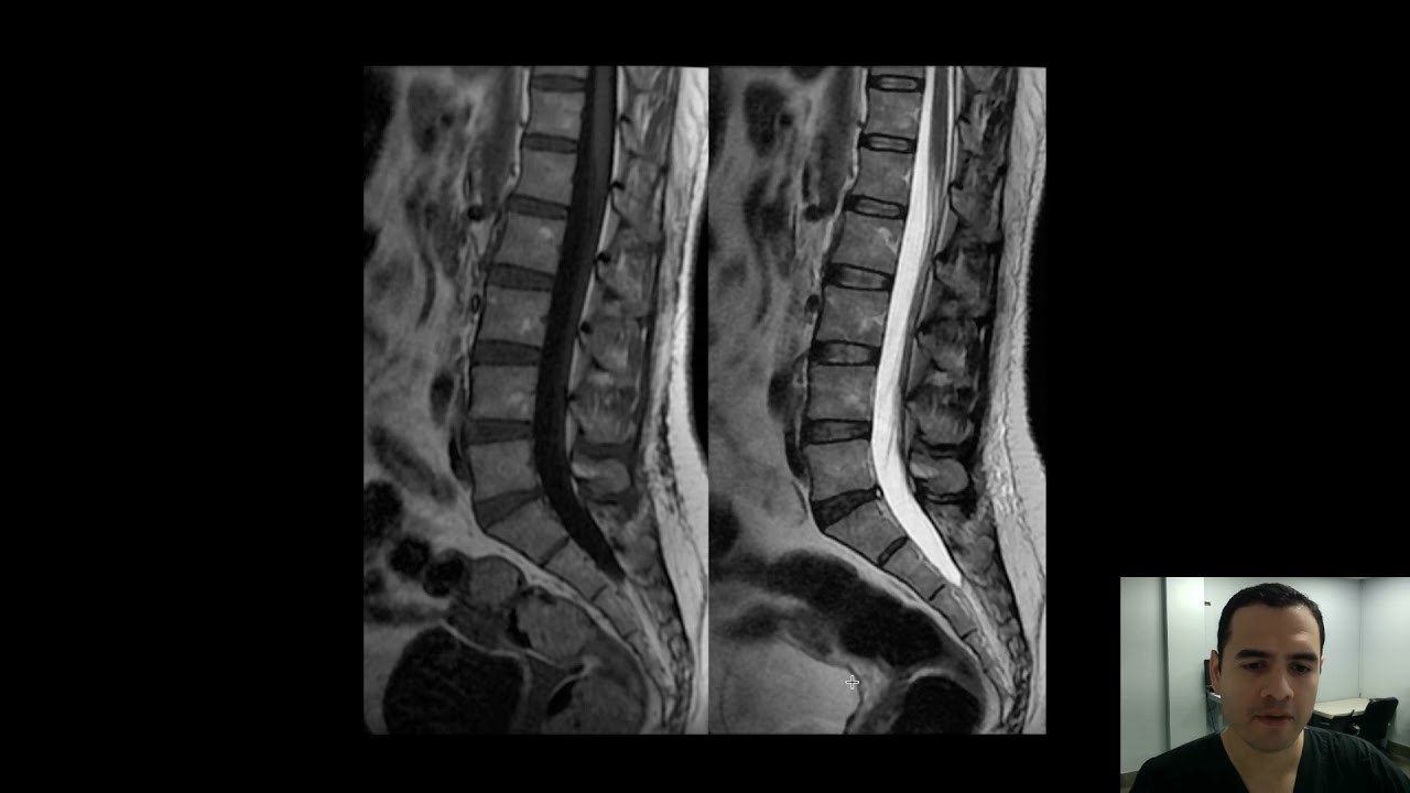 Verschil T1 En T2 Mri