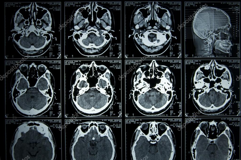 MRI scan hersenen — Stockfoto #24114333 - Wanneer Contrastvloeistof Bij Mri-scan Hersenen