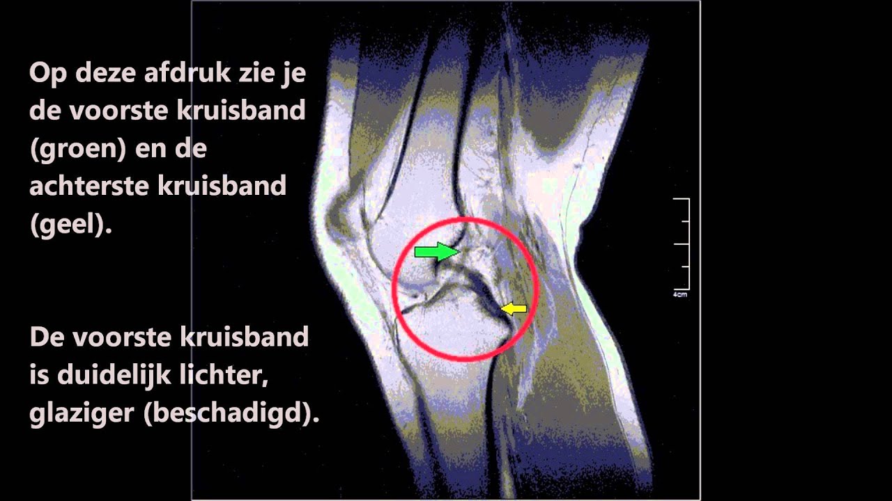 MRI scan van een geblesseerde knie - YouTube - Hoe Ziet Een Kwaadaardige Tumor Eruit