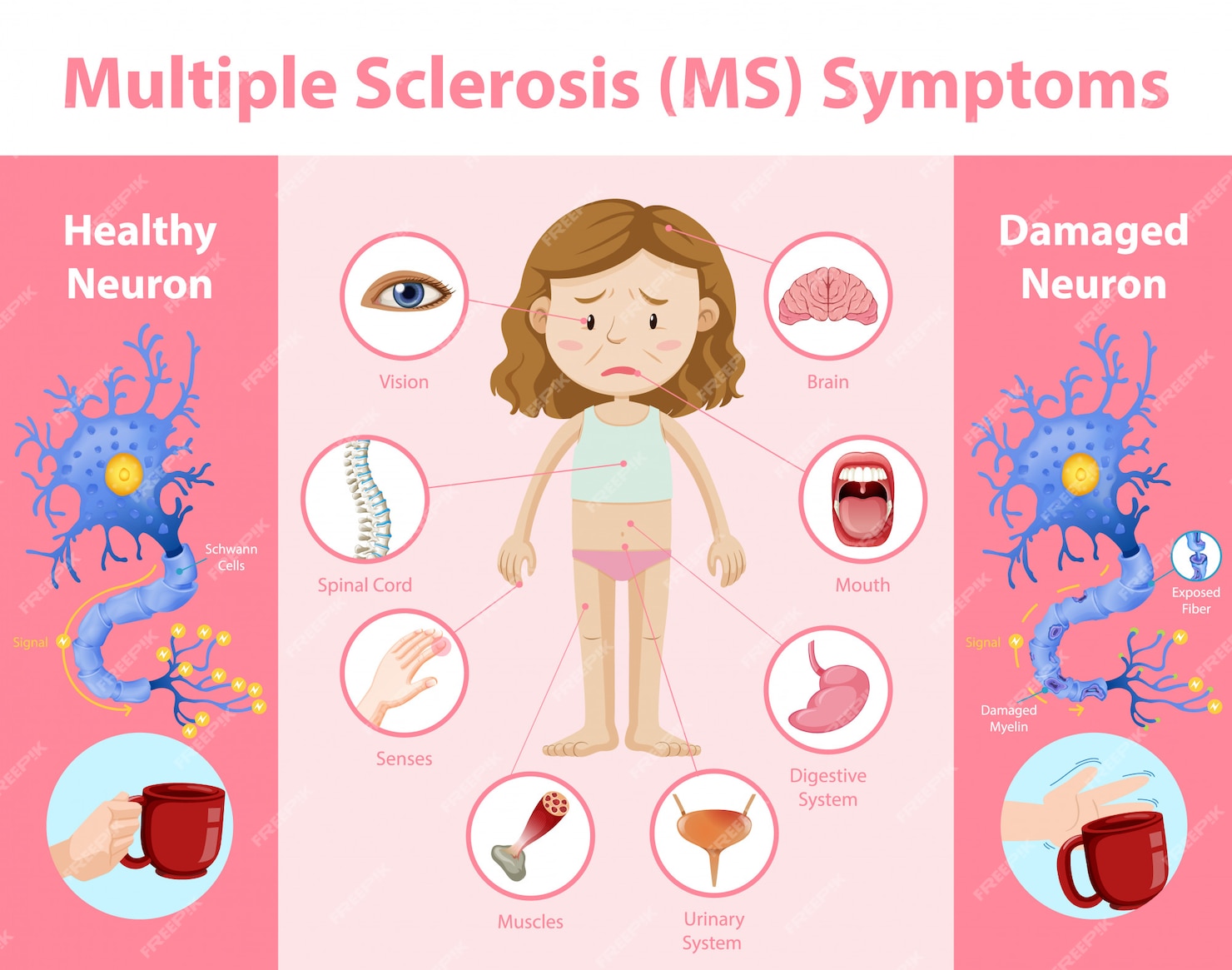 Multiple sclerose (ms) symptomen informatie infographic | Gratis Vector - Wat Is Ms Voor Ziekte