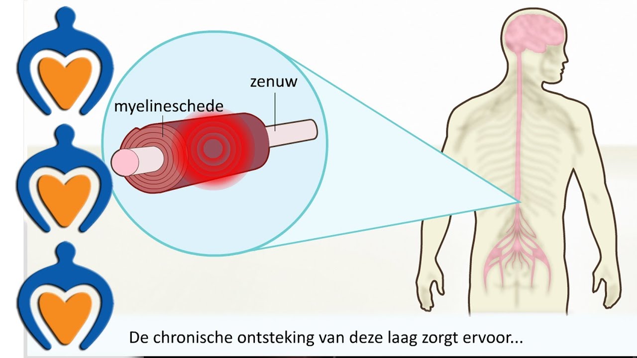 Multiple Sclerose (MS) - Wat is het en wat zijn de symptomen? - YouTube - Ms Ziekte Wat Is Dat