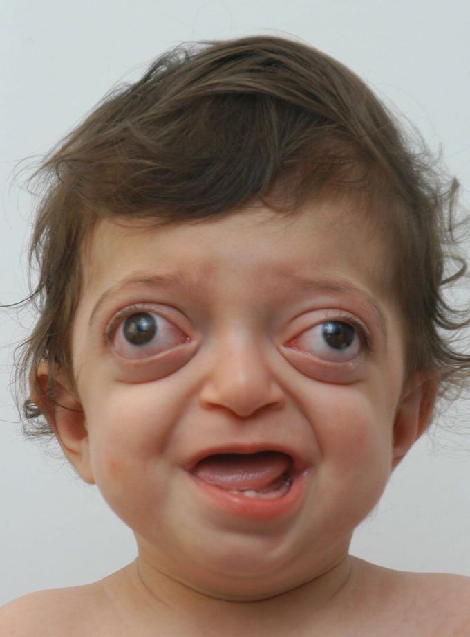 Name the syndrome?!# - MEDizzy - Syndrome De Gilles De La Tourette