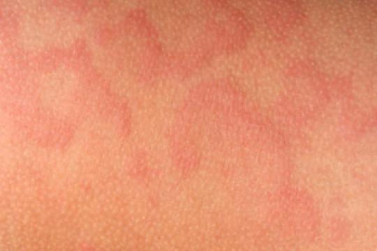 Netelroos | Thuisarts.nl - Netelroos Rode Vlekken Op Huid Door Stress