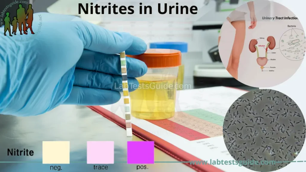 Nitrites in Urine Test: Overview, Procedure, Results Interpretation - Wat Is Nitriet In Urine