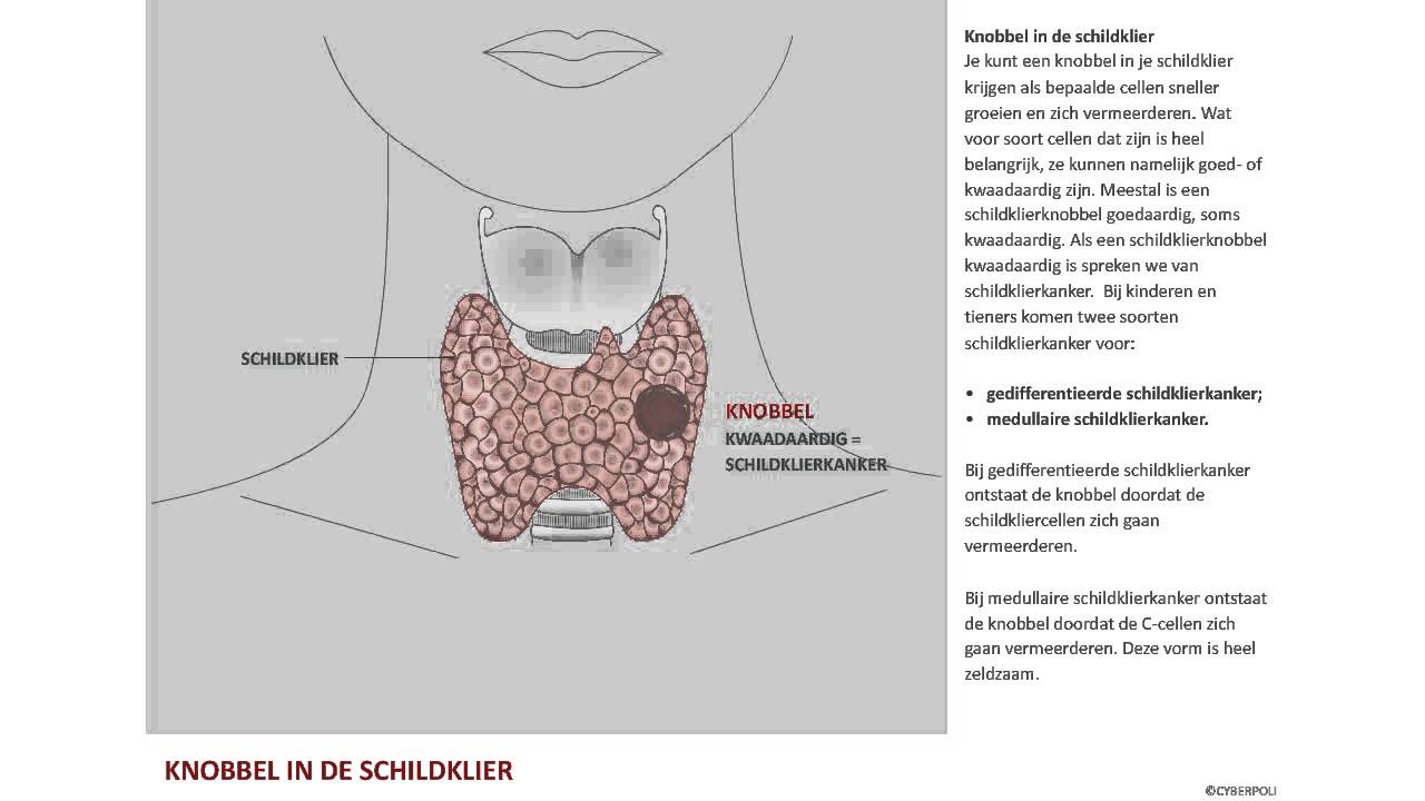 Nodus, een knobbel in de schildklier - YouTube - Hoe Voelt Een Kwaadaardig Knobbeltje Oksel