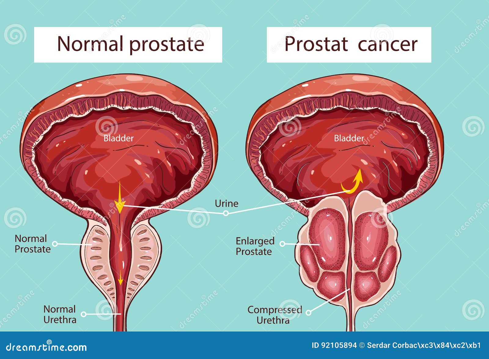 Normal Prostate And Benign Prostatic Hyperplasia Vector Illustration - Waar Zit De Prostaat Bij Een Man