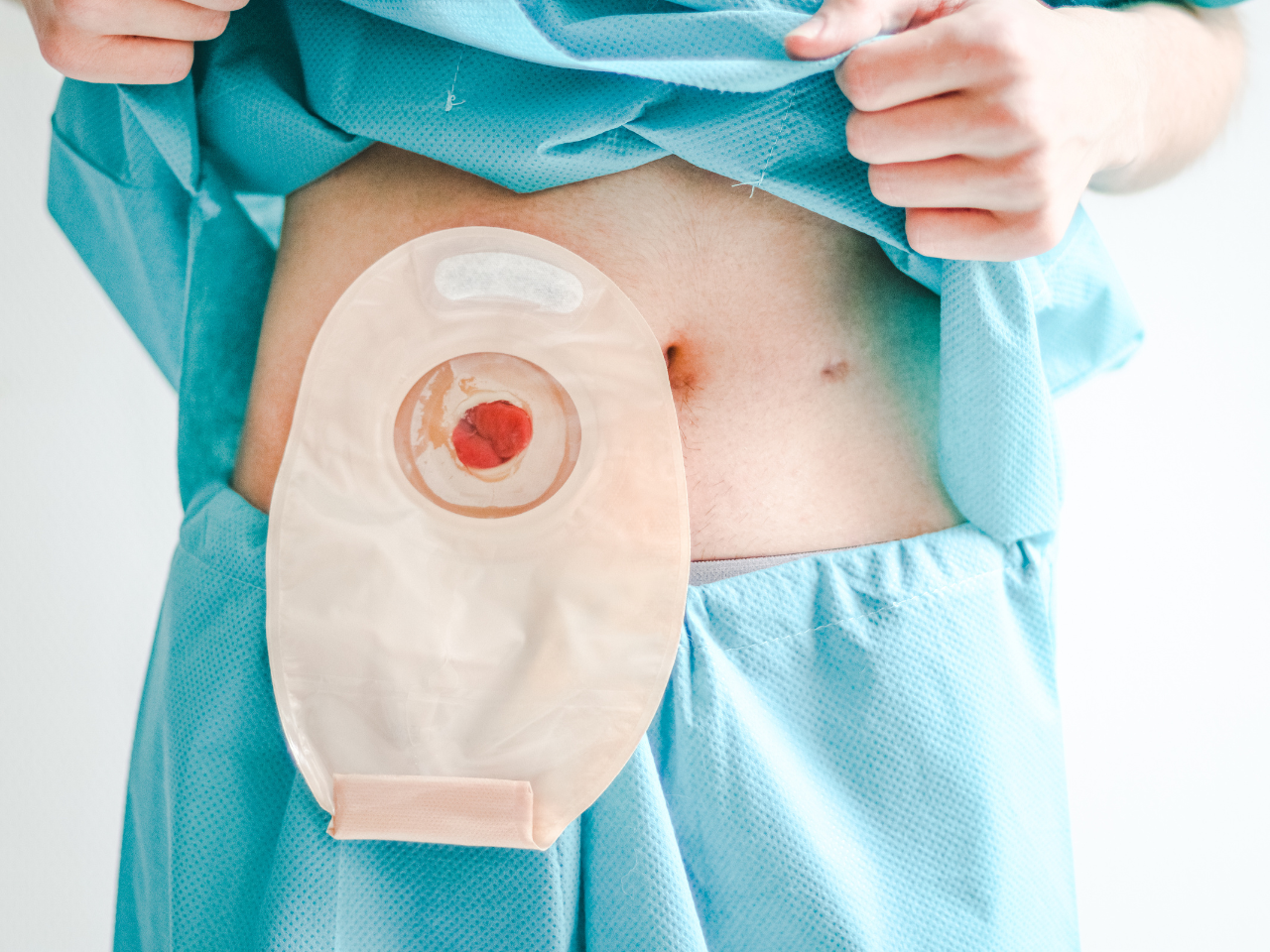 Normal Stoma Colostomy - Stoma Toch Ontlasting Via Anus