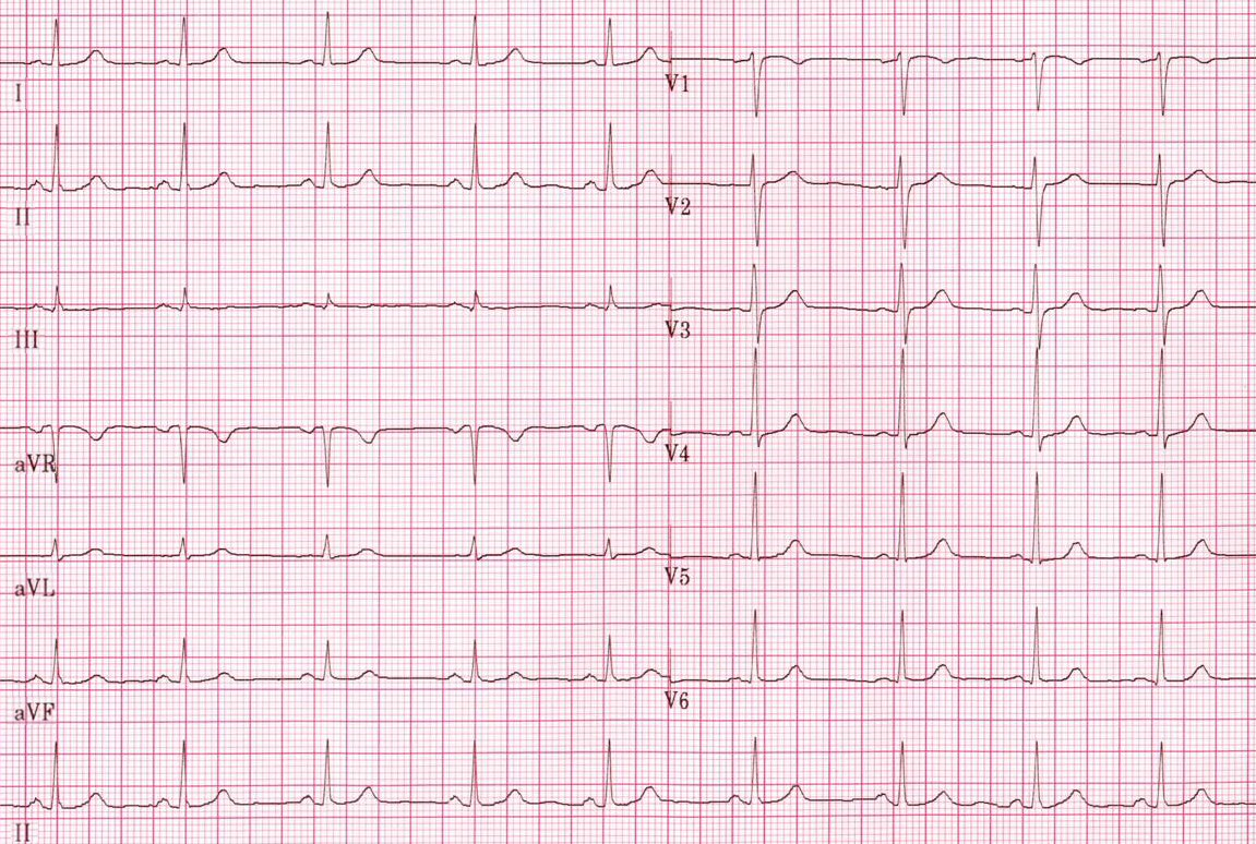 Normal Tracing - ECGpedia - Hoe Ziet Een Normaal Ecg Eruit