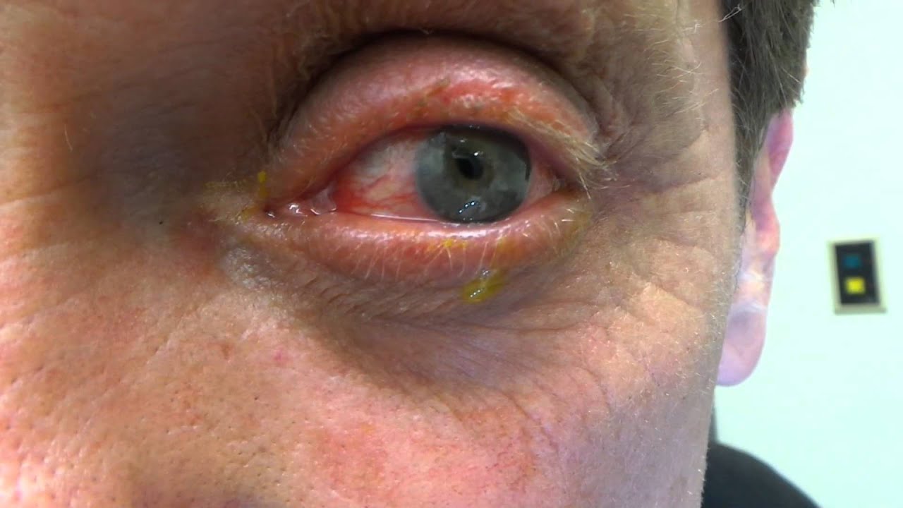 Open Corneal Injury and Protruding Iris - YouTube - Waardoor Wordt Stomp Oogletsel Veroorzaakt