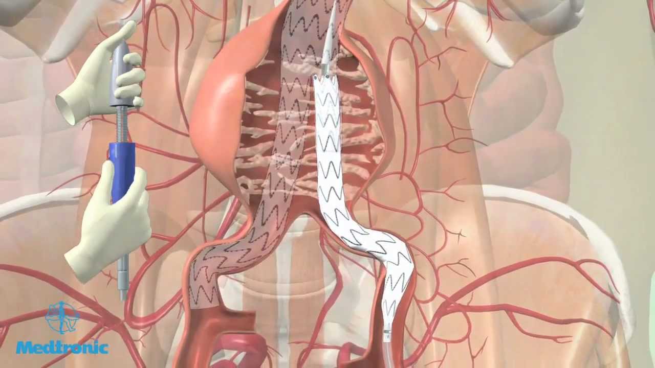 Operatie aneurysma van de buikslagader (EVAR-procedure) - YouTube - Vernauwing Aorta In De Buik